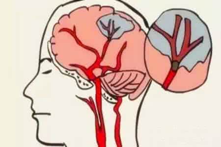 老人脑血管疾病的经络保健